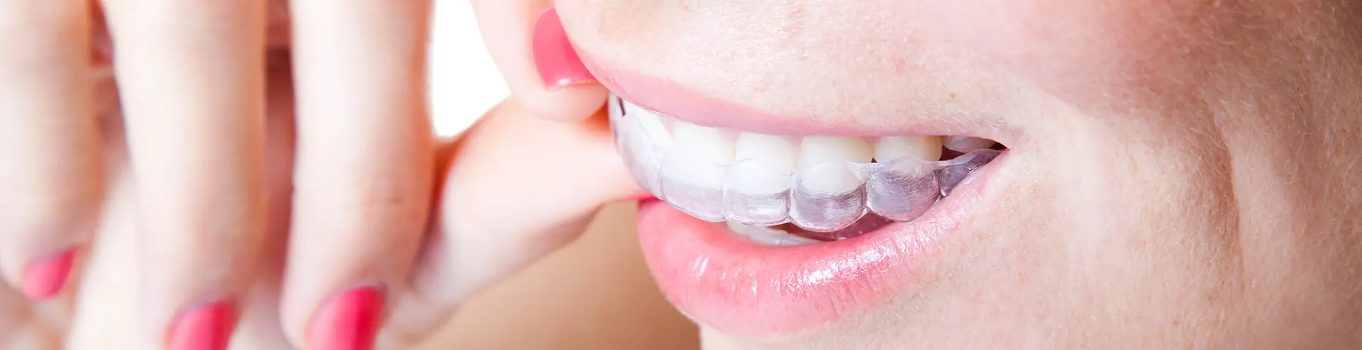 Invisalign vs Braces: Which Choice is Right for You? - Arrow Smile