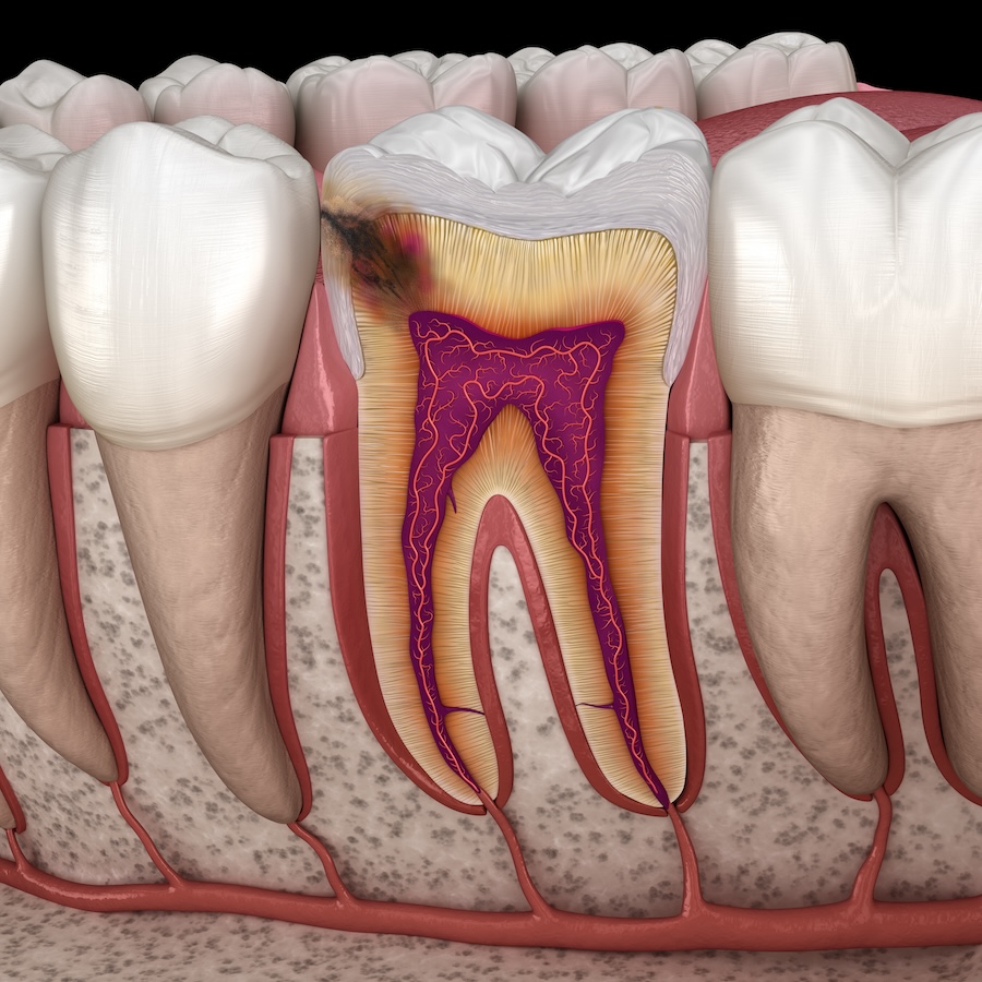 prevent cavities, cavity prevention, dental hygiene, oral health, Lynn Lane Family Dentistry, Broken Arrow dentist, Dr. Valerie Holleman, cavity treatment, fluoride